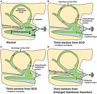 Current Trends, Controversies, and Future Directions in the Evaluation and Management of Superior Canal Dehiscence Syndrome